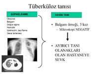 Tüberküloz Tanısı Belirtileri ve Tedavisi Tüberküloz Tanısı Belirtileri ve Tedavisi