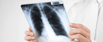 Miliyer Tüberküloz Belirtileri ve Tedavisi